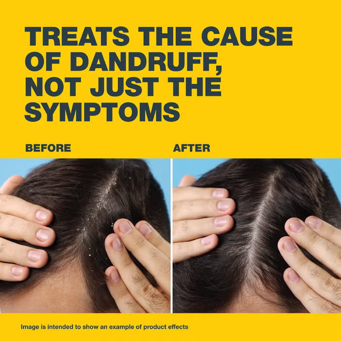 Nizoral® 2% Anti-Dandruff Shampoo, 100ml, Medical Treatment with Ketoconazole, Clinically Proven to Treat Dandruff, Flakes & Itching cart saudia